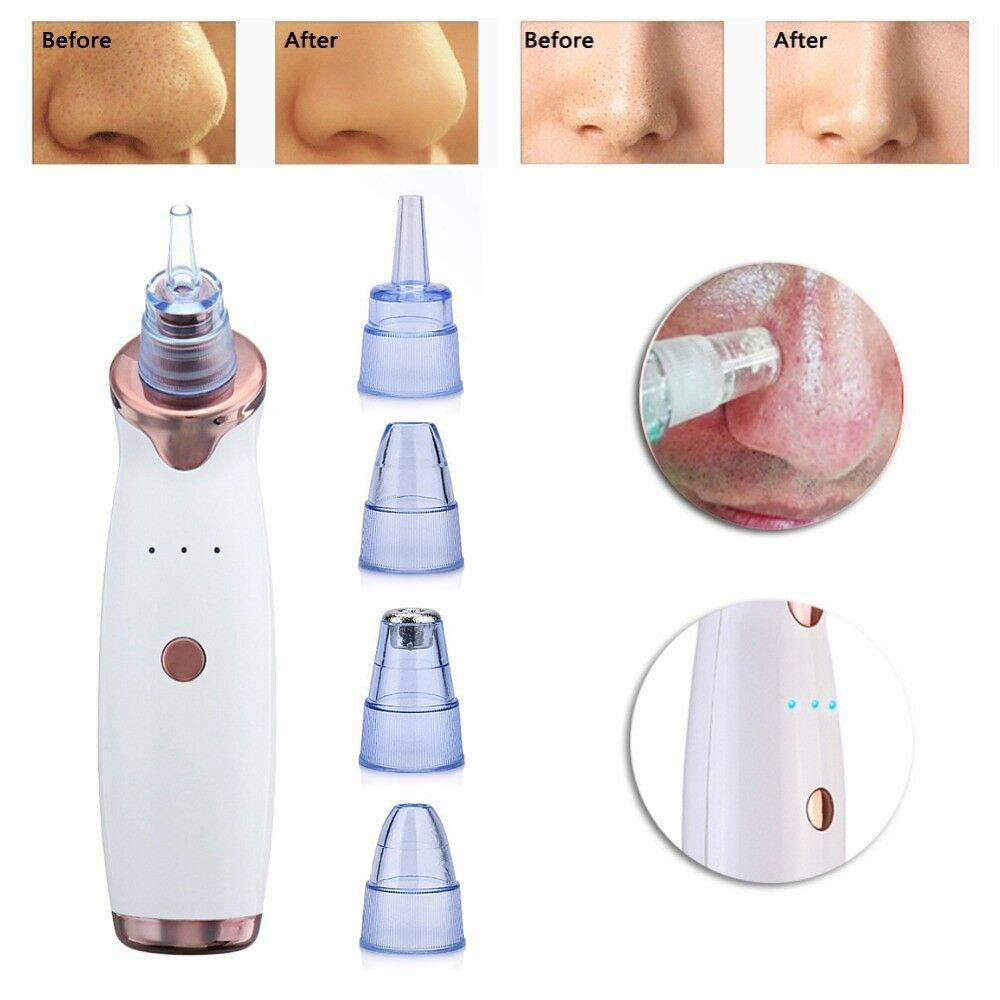 Blackhead Remover Vacuum - Pimple & Acne Suction Tool