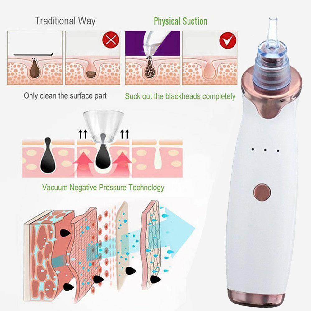 Blackhead Remover Vacuum - Pimple & Acne Suction Tool